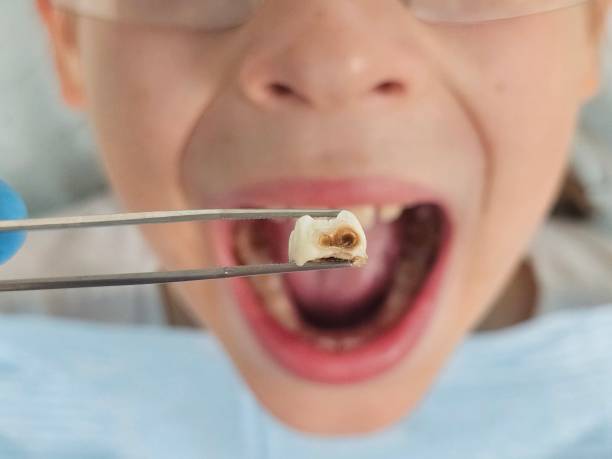 Best Emergency Tooth Extraction in Leesburg, OH